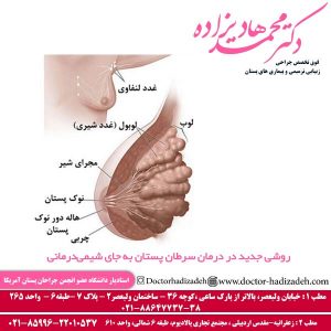 روشی جدید در درمان سرطان سینه + دکتر محمد هادیزاده