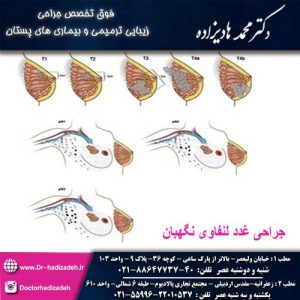 جراحی غدد لنفاوی نگهبان - دکتر هادیزاده