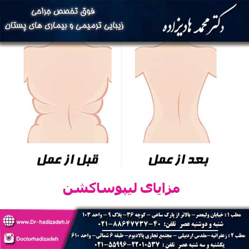 مزایای لیپوساکشن - دکتر هادیزاده