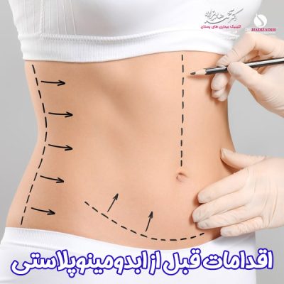 اقدامات قبل از ابدومینوپلاستی - دکتر هادیزاده