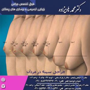 جراحی سینه در مردان - دکتر هادیزاده