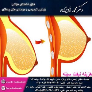 هزینه لیفت سینه در تهران - دکتر هادیزاده
