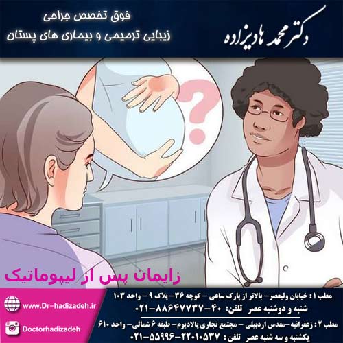 زایمان پس از لیپوماتیک