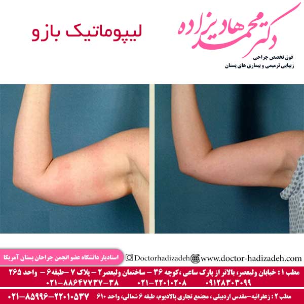 لیپوماتیک بازو - دکتر هادیزاده