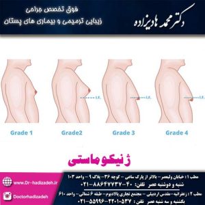 ژنیکوماستی - دکتر محمد هادیزاده