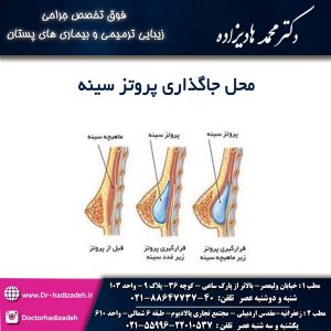 محل جاگذاری پروتز سینه