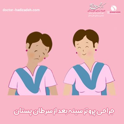 پروتز سینه بعد از سرطان - دکتر هادیزاده