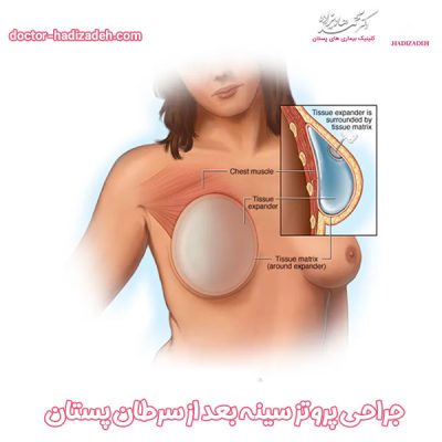 پروتز سینه بعد از سرطان - دکتر هادیزاده