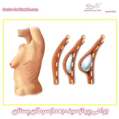 پروتز سینه بعد از سرطان - دکتر هادیزاده