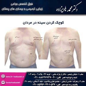 جراحی کوچک کردن سینه