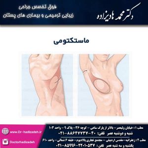 ماستکتومی - دکتر هادیزاده 