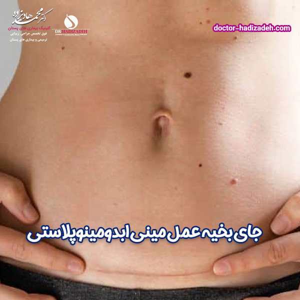 مینی ابدومنیوپلاستی - دکتر هادیزاده
