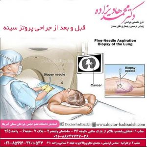 قبل و بعد از جراحی پروتز سینه