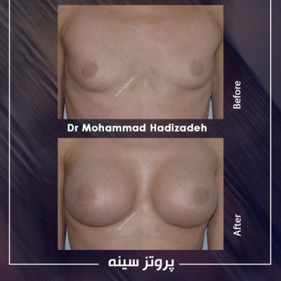 قبل و بعد از جراحی پروتز سینه - دکتر محمد هادیزاده