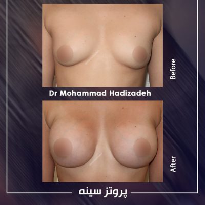 قبل و بعد از جراحی پروتز سینه - دکتر محمد هادیزاده