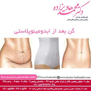گن بعد از ابدومینوپلاستی - دکتر هادیزاده