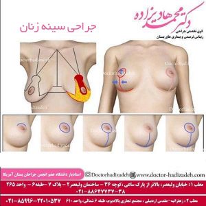 جراحی سینه زنان