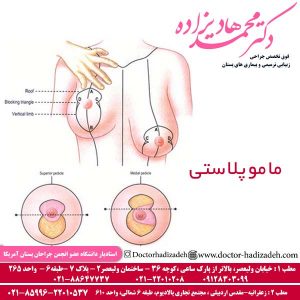 ماموپلاستی - دکتر محمد هادیزاده
