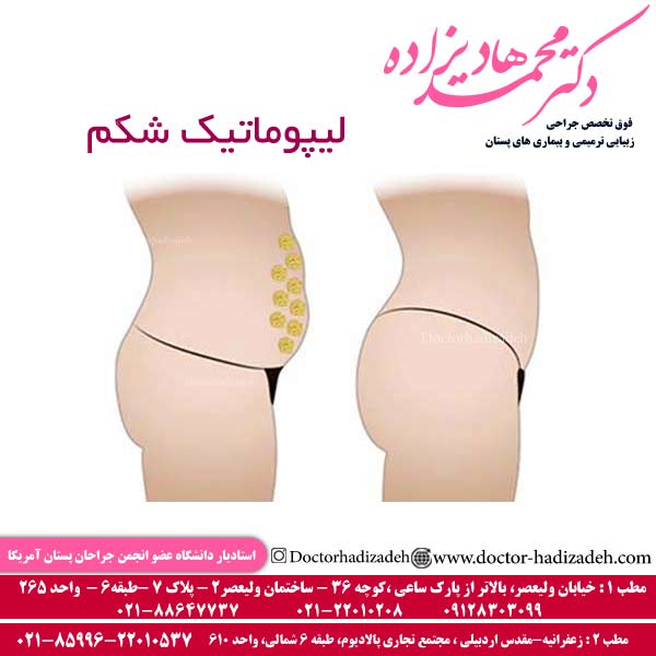 لیپوماتیک شکم