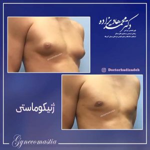ژنیکوماستی - دکتر هادیزاده