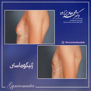 ژنیکوماستی - دکتر هادیزاده