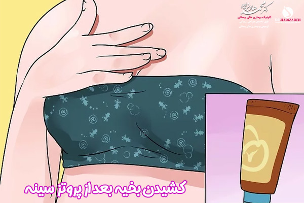 مراقبت های بعد از پروتز سینه - دکتر محمد هادیزاده