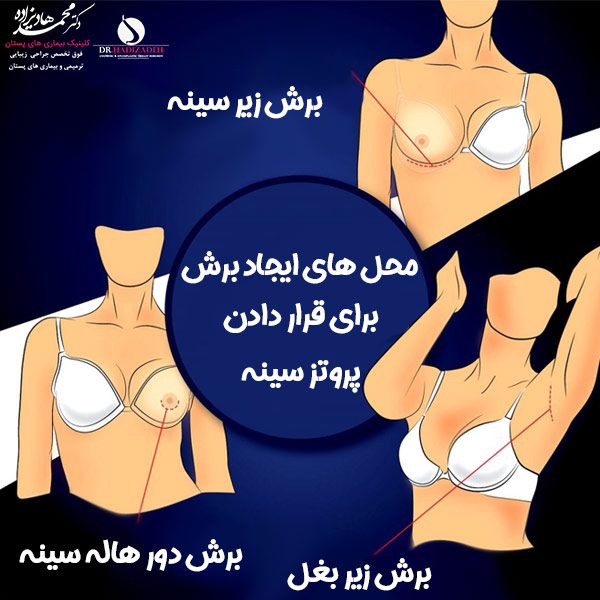 پروتز سینه + دکتر هادیزاده