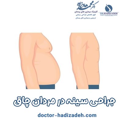 جراحی سینه در مردان - دکتر هادیزاده