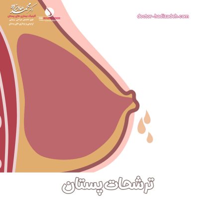 ترشح پستان - دکتر هادیزاده