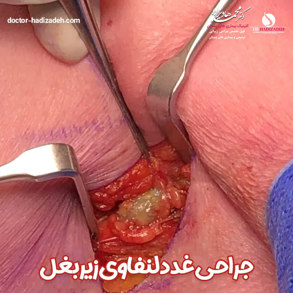 جراحی غدد لنفاوی زیر بغل - دکتر هادیزاده