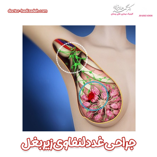 جراحی غدد لنفاوی زیر بغل - دکتر هادیزاده