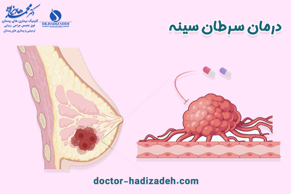 درمان سرطان سینه | دکتر هادیزاده