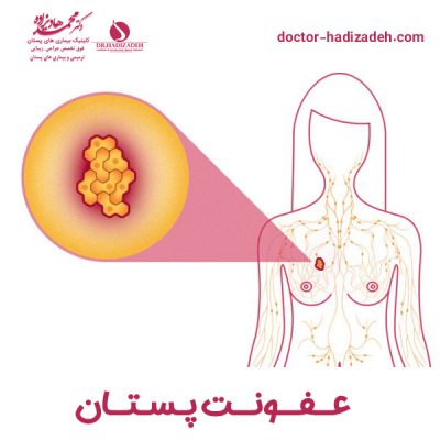 عفونت پستان - دکتر هادیزاده