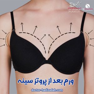 ورم بعد از پروتز سینه - دکتر هادیزاده