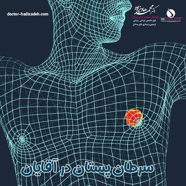 سرطان پستان در آقایان - دکتر هادیزاده