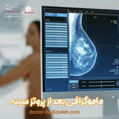 ماموگرافی بعد از پروتز سینه - دکتر هادیزاده