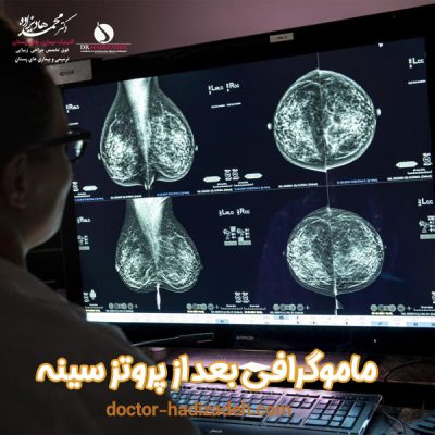 ماموگرافی بعد از پروتز سینه - دکتر هادیزاده