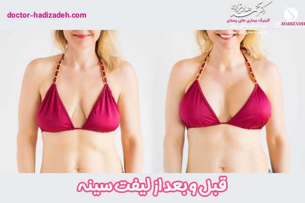 لیفت سینه - دکتر محمد هادیزاده