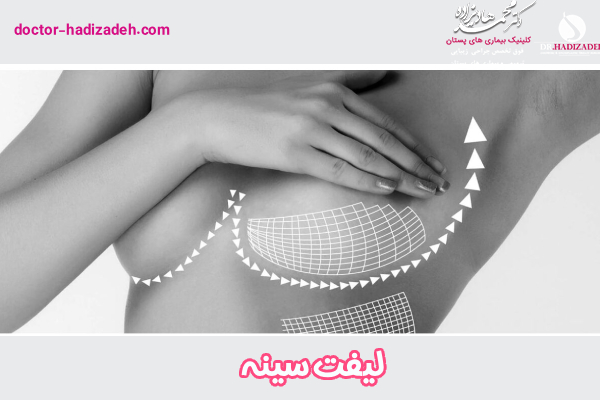 لیفت سینه - دکتر محمد هادیزاده