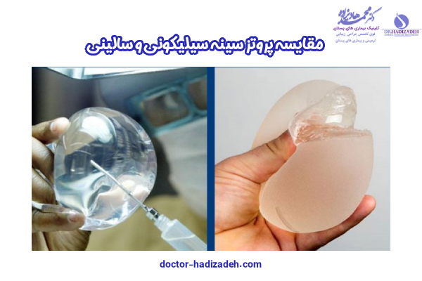 پروتز سینه سیلیکونی - دکتر هادیزاده