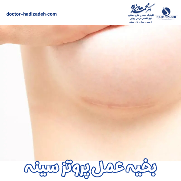 بخیه عمل پروتز سینه - دکتر هادیزاده