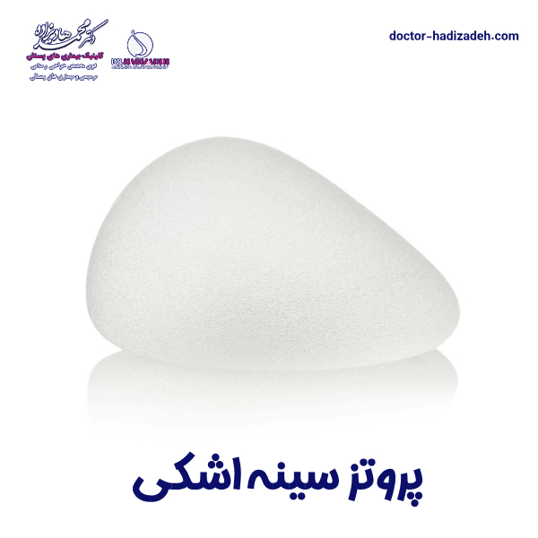 پروتز اشکی - دکتر هادیزاده