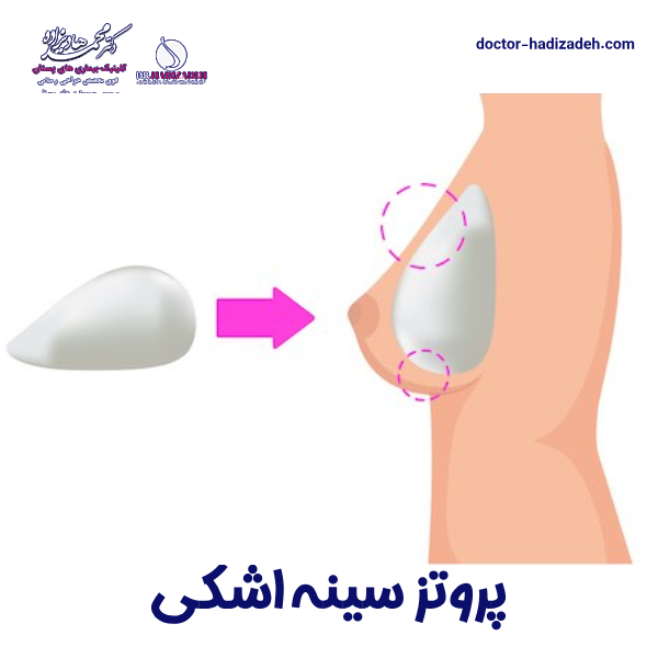 پروتز سینه اشکی - دکتر هادیزاده