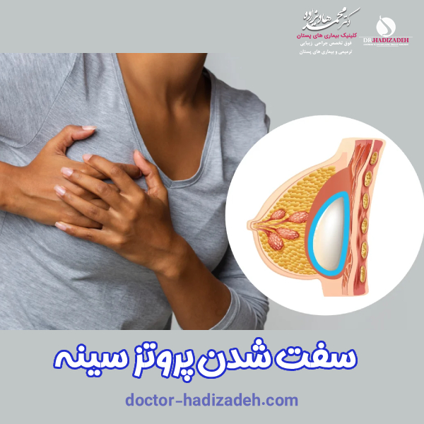 سفت شدن پروتز سینه - دکتر محمخد هادیزاده