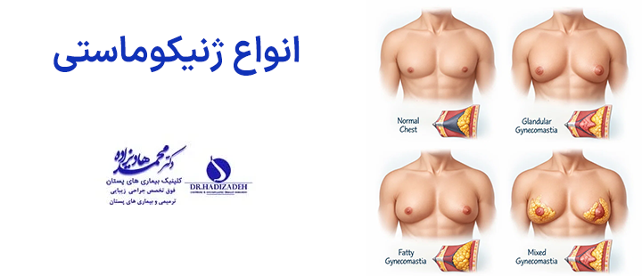 انواع ژنیکوماستی