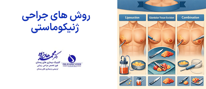 روش های جراحی ژنیکوماستی
