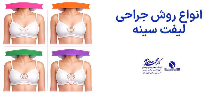 انواع روش جراحی لیفت سینه