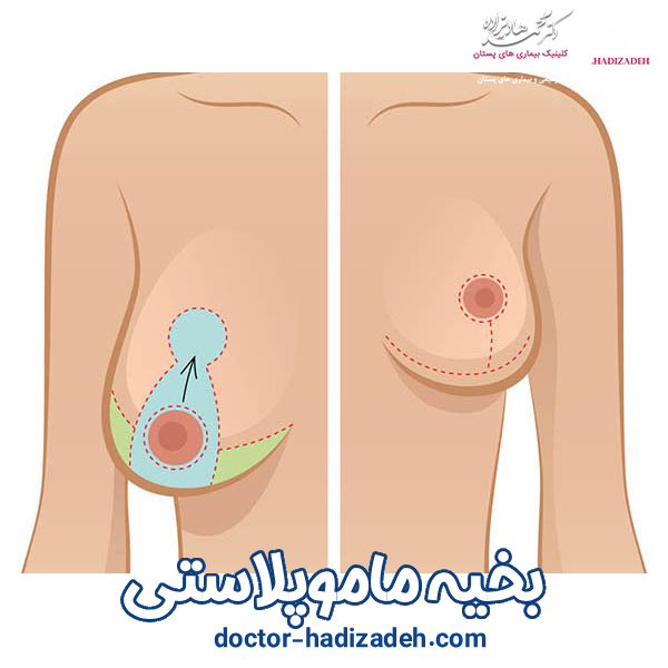 بخیه ماموپلاستی - دکتر محمد هادیزاده