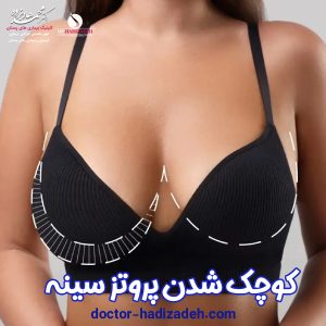 کوچک شدن پروتز سینه - دکتر محمد هادیزاده