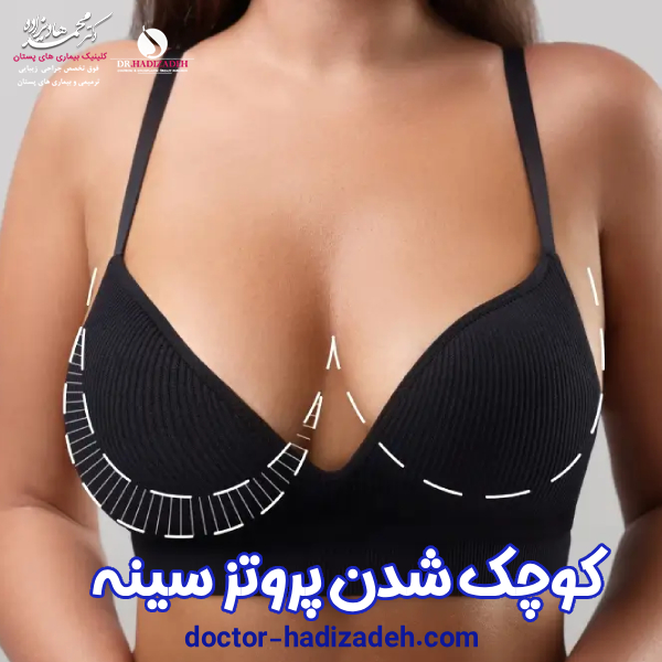 کوچک شدن پروتز سینه - دکتر محمد هادیزاده
